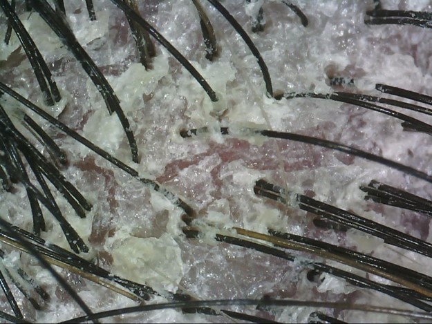 Scalp Psoriasis photo AROMASE