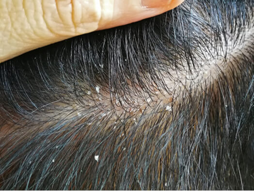 Dandruff AROMASE scalp study case