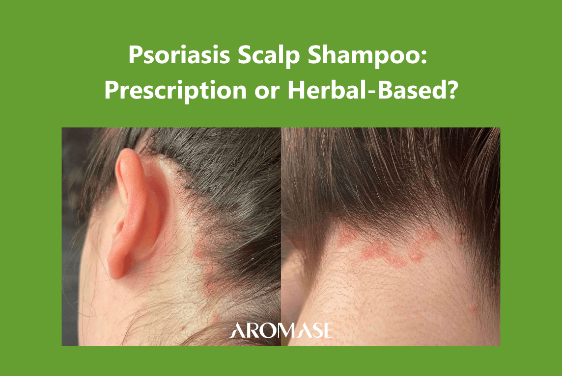 Scalp Psoriasis Shampoo Prescription or Herbal-Based AROMASE