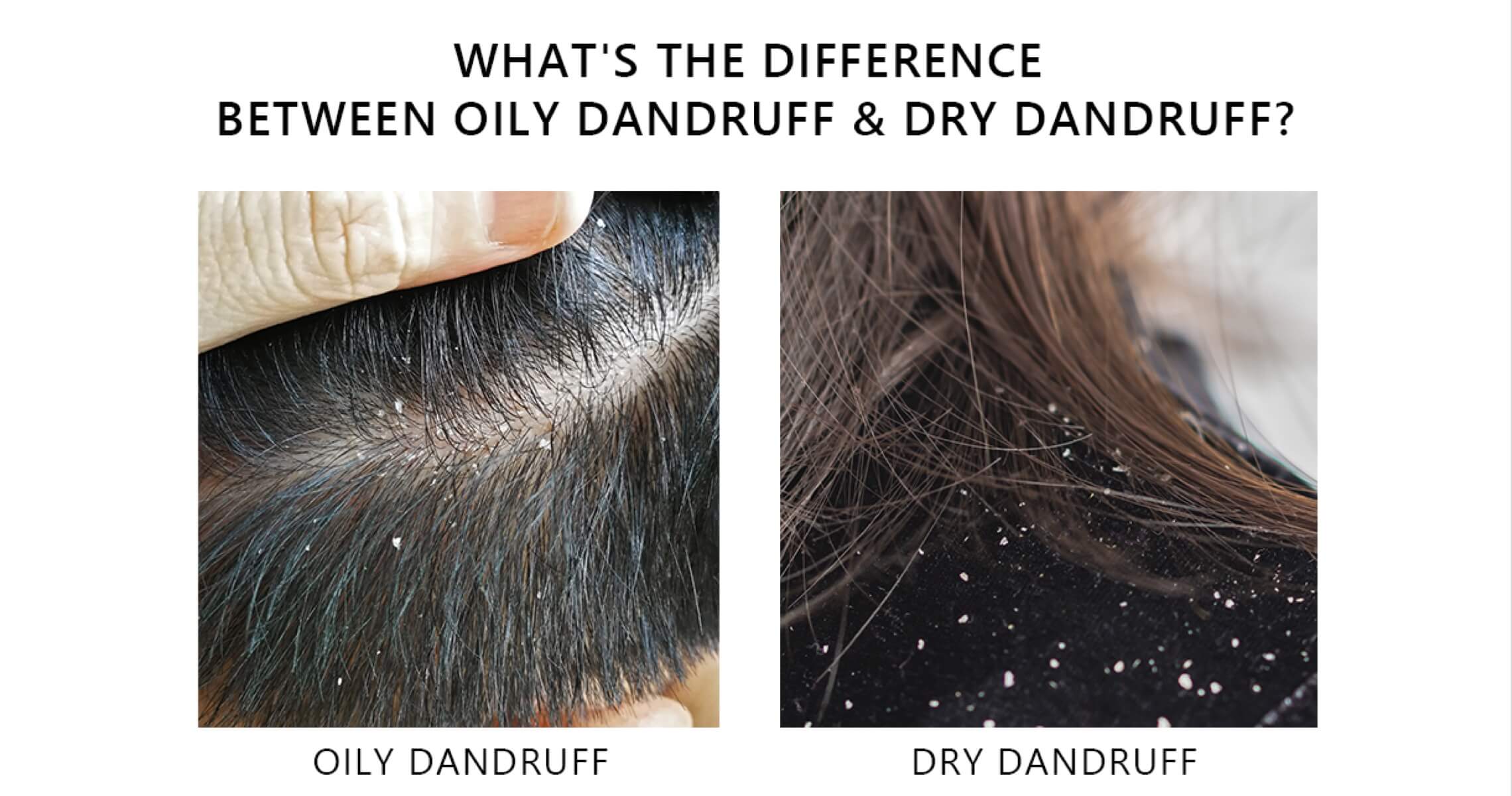 OILY Dandruff vs. DRY Dandruff: Causes, Differences, Symptoms Photos, and Treatments AROMASE scalp care