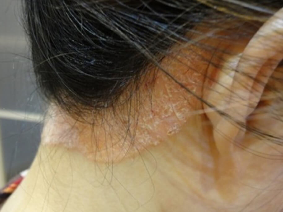 Scalp Psoriasis Treatment Cause Prevention AROMASE